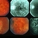 Choroiditis Choroiditis
